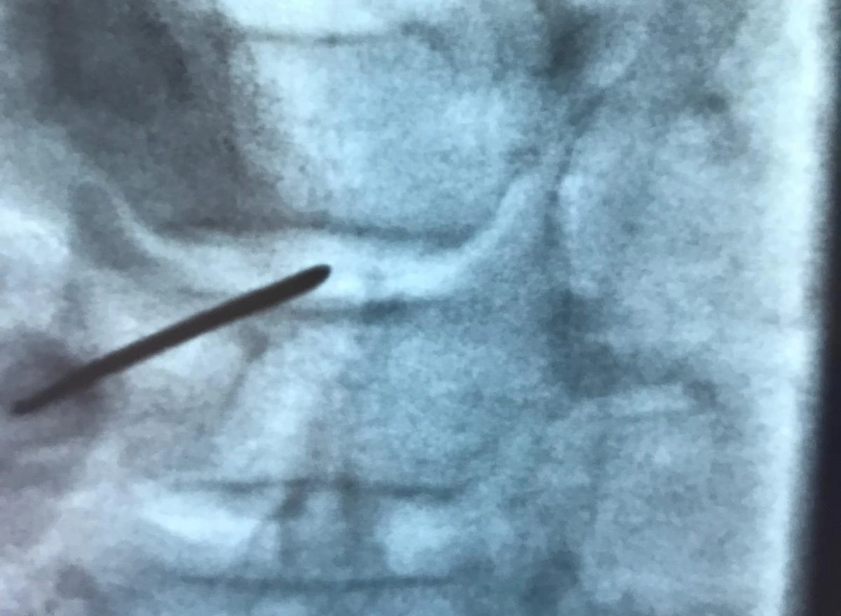 صورة تنظير فلوري تُظهر إبرة موجهة داخل العمود الفقري — مرئية على الشاشة في الوقت الحقيقي